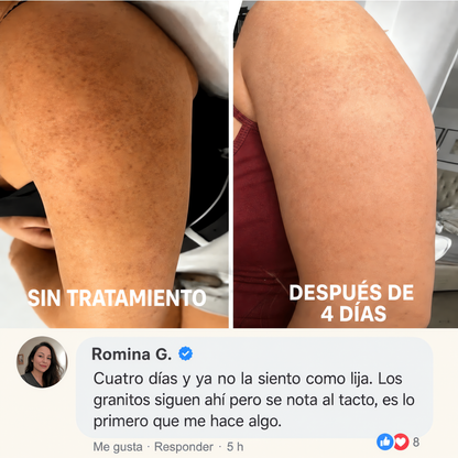 TERSO | Crema contra la queratosis pilaris y piel de gallina