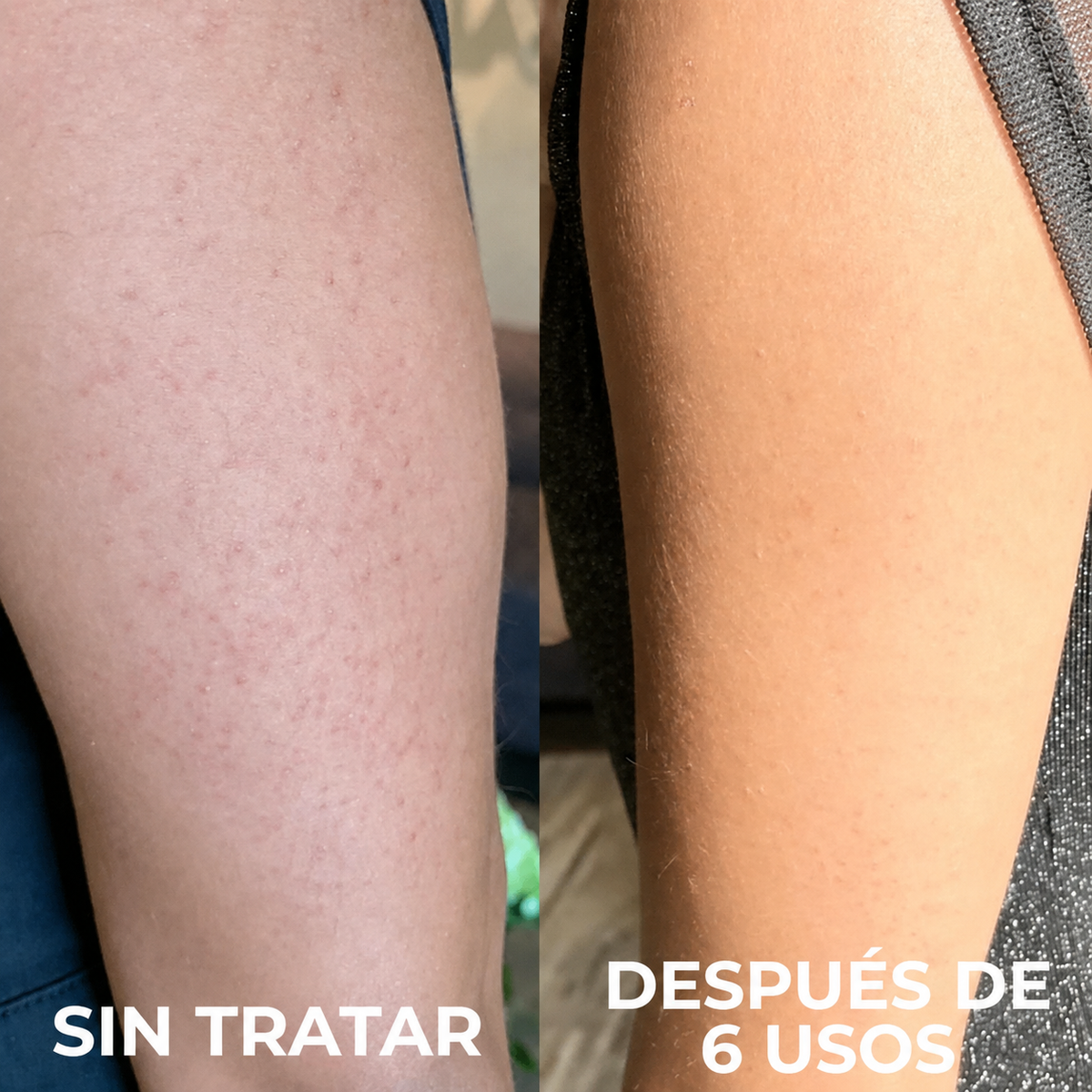 TERSO | Crema contra la queratosis pilaris y piel de gallina