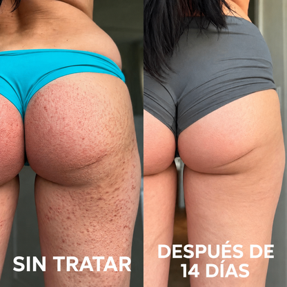 TERSO | Crema contra la queratosis pilaris y piel de gallina