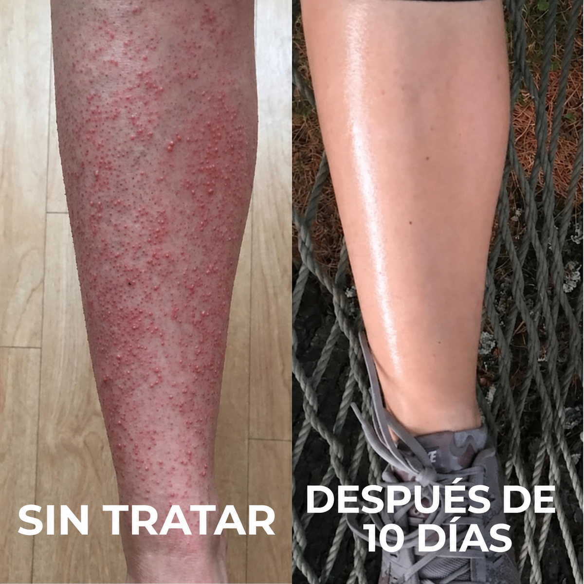 TERSO | Crema contra la queratosis pilaris y piel de gallina