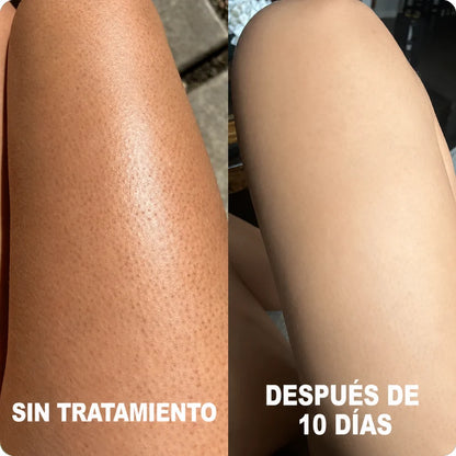 TERSO | Crema contra la queratosis pilaris y piel de gallina